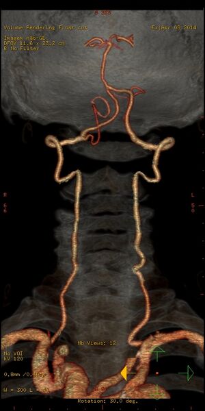File:Carotid artery stenosis (Radiopaedia 28786-29086 B 1).jpg