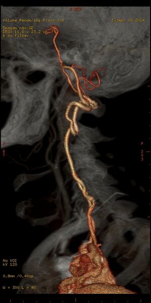 File:Carotid artery stenosis (Radiopaedia 28786-29086 B 5).jpg