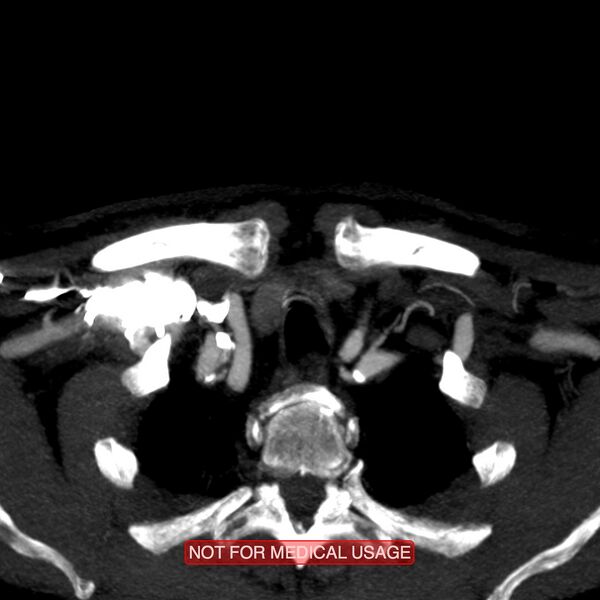 File:Carotid artery stenosis (Radiopaedia 28786-29086 C 26).jpg