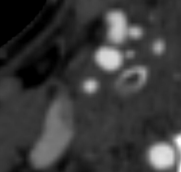 File:Carotid near-occlusion (Radiopaedia 85304-100887 M 72).jpg