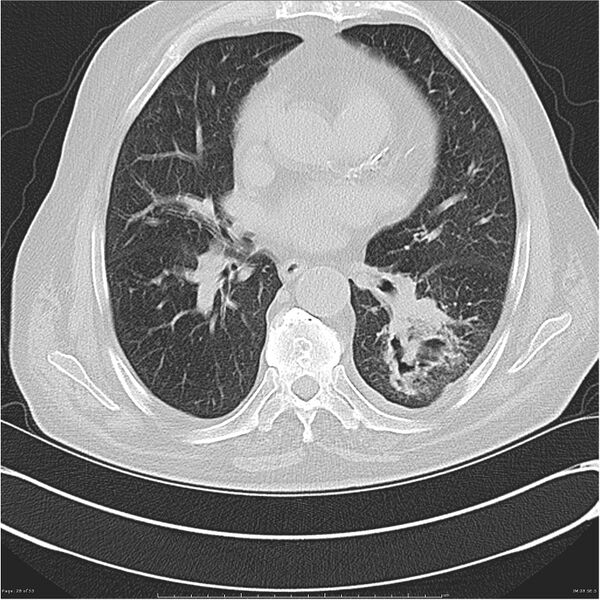 File:Cavitating left lower lobe lesion - squamous cell lung cancer (Radiopaedia 27749-28176 Axial lung window 28).jpg