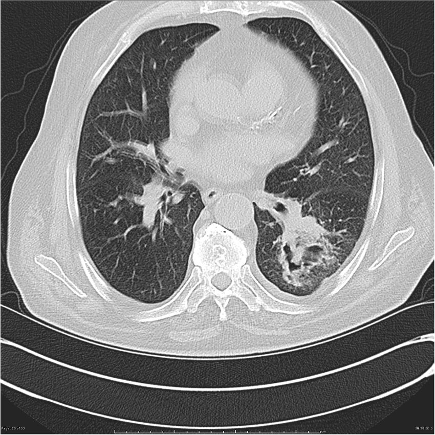 Cavitating left lower lobe lesion - squamous cell lung cancer (Radiopaedia 27749-28176 Axial lung window 28).jpg