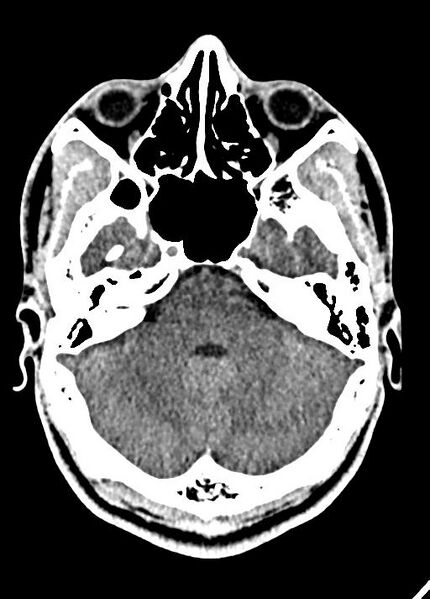 File:Cavum septum pellucidum and cavum vergae (Radiopaedia 77797-90060 Axial Brain Window 27).jpg