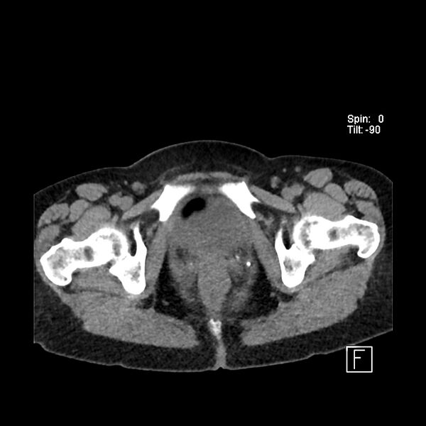 File:Cecal volvulus (Radiopaedia 90897-108397 Axial non-contrast 68).jpg
