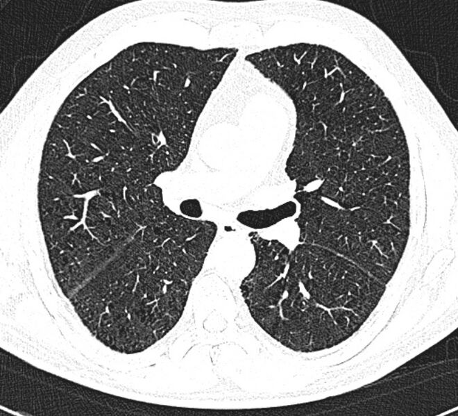 File:Centrilobular pulmonary emphysema (Radiopaedia 26808-26971 Axial lung window 19).jpg