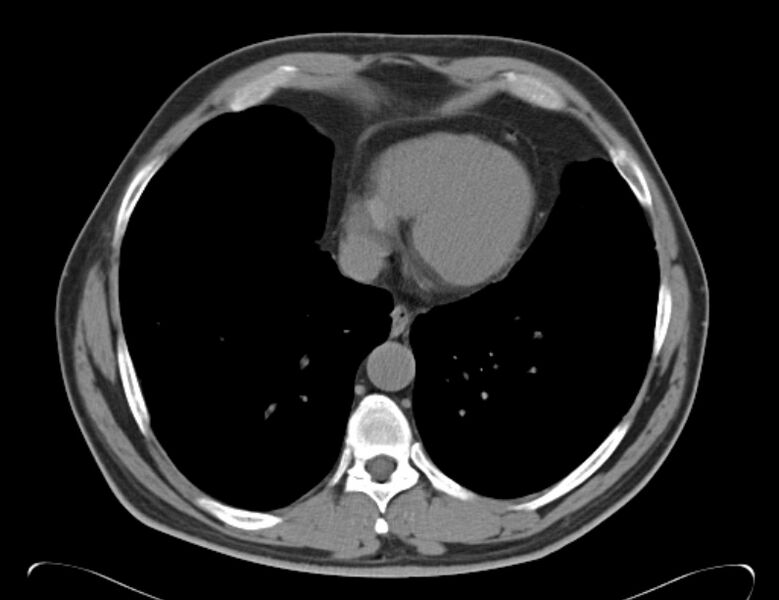 File:Centrilobular pulmonary emphysema (Radiopaedia 26808-26971 Axial non-contrast 32).jpg