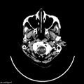 Cerebellar and intraventricular hemorrhage with obstructive hydrocephalus (Radiopaedia 33524).jpg