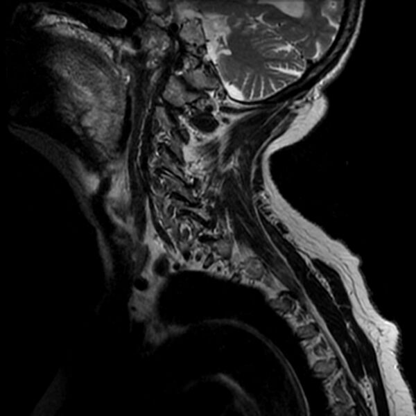 File:Cerebellar ataxia with neuropathy and vestibular areflexia syndrome (CANVAS) (Radiopaedia 74283-85159 Sagittal T2 11).jpg