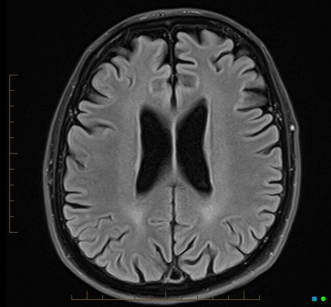 File:Cerebellar gangliocytoma (Radiopaedia 65377-74422 Axial FLAIR 25).jpg