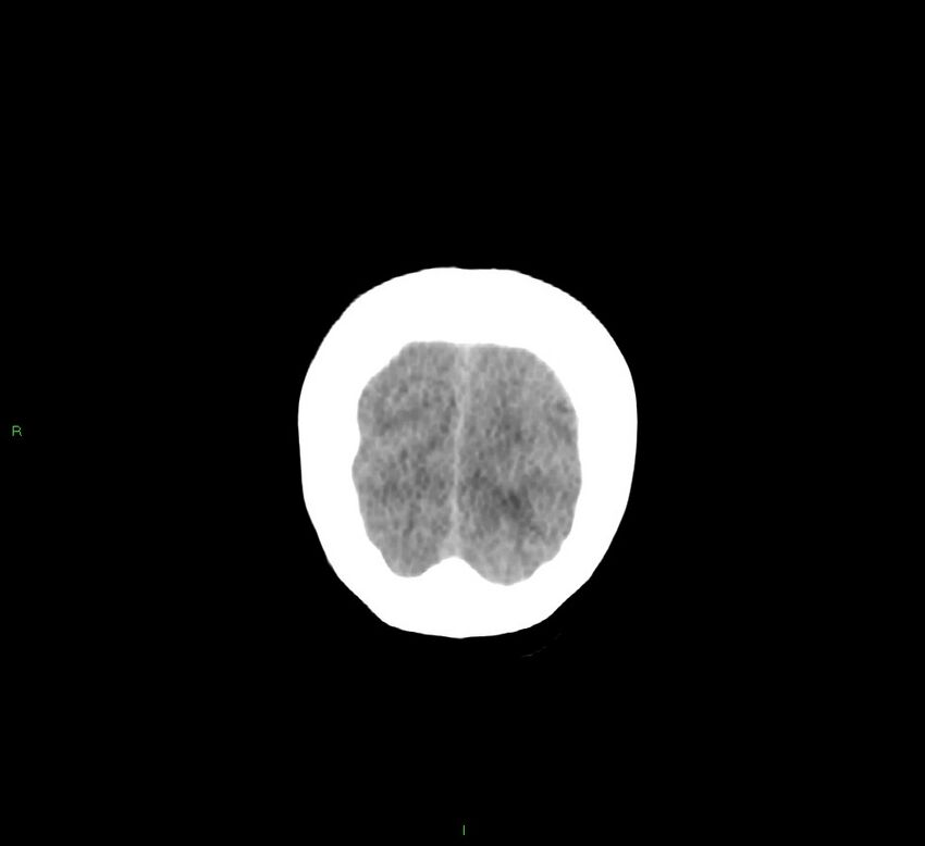 Cerebellar hemorrhage (Radiopaedia 58793-66027 Coronal non-contrast 10).jpg