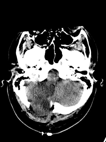 File:Cerebellar infarct due to vertebral artery dissection with posterior fossa decompression (Radiopaedia 82779-97032 Axial non-contrast 5).png