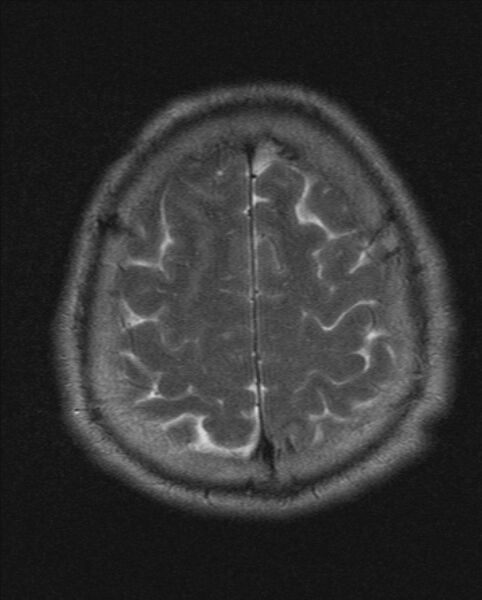 File:Cerebellopontine angle meningioma (Radiopaedia 24459-24764 Axial T2 20).jpg
