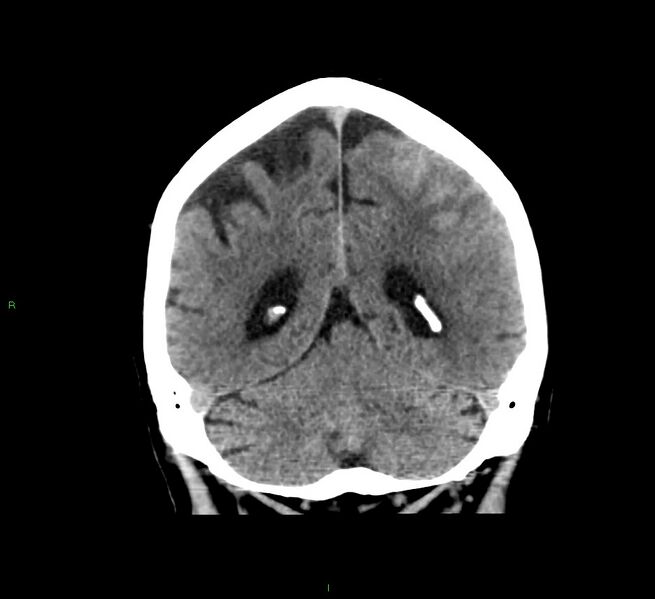 File:Cerebral amyloid angiopathy-associated lobar intracerebral hemorrhage (Radiopaedia 58376-65511 Coronal non-contrast 22).jpg