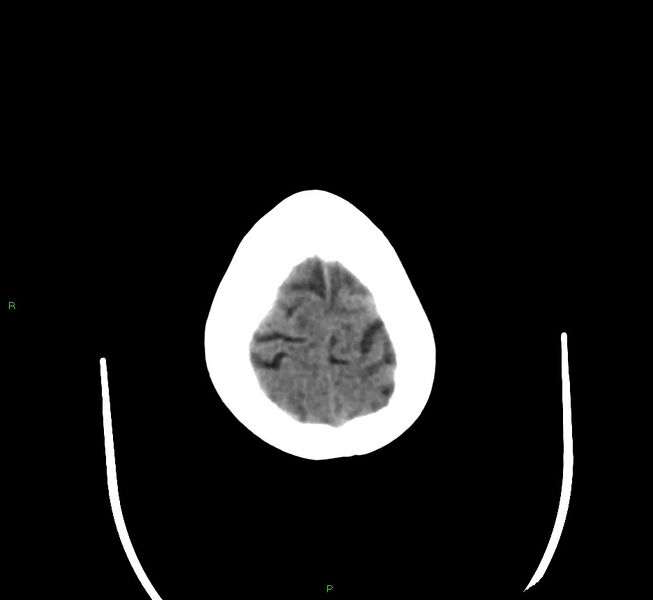 File:Cerebral amyloid angiopathy-associated lobar intracerebral hemorrhage (Radiopaedia 58377-65514 Axial non-contrast 6).jpg