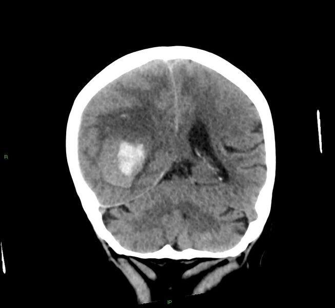 File:Cerebral amyloid angiopathy-associated lobar intracerebral hemorrhage (Radiopaedia 58563-65727 Coronal non-contrast 25).jpg