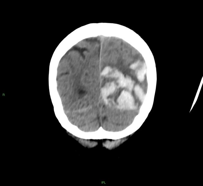 File:Cerebral amyloid angiopathy-associated lobar intracerebral hemorrhage (Radiopaedia 58754-65975 Coronal non-contrast 14).jpg