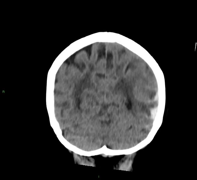 File:Cerebral amyloid angiopathy-associated lobar intracerebral hemorrhage (Radiopaedia 58757-65978 Coronal non-contrast 20).jpg