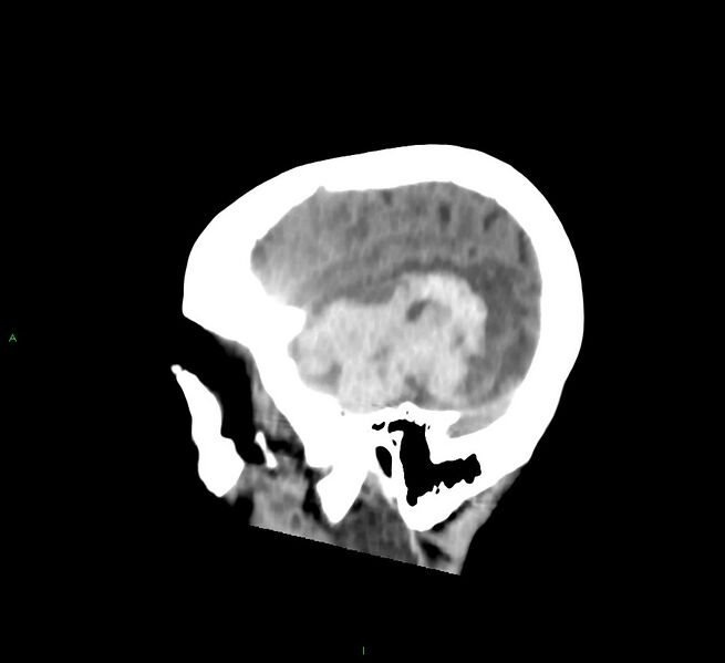File:Cerebral amyloid angiopathy-associated lobar intracerebral hemorrhage (Radiopaedia 58758-65980 C 10).jpg