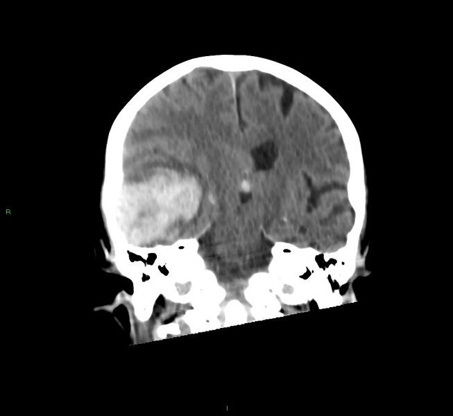 File:Cerebral amyloid angiopathy-associated lobar intracerebral hemorrhage (Radiopaedia 58758-65980 Coronal non-contrast 32).jpg