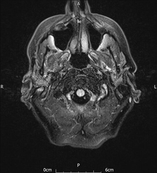 File:Cerebral amyloid angiopathy related inflammation (Radiopaedia 72772-83415 Axial FLAIR 2).jpg