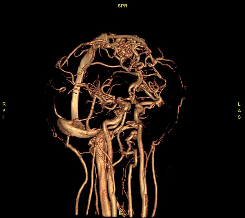 Cerebral arteriovenous malformation (Radiopaedia 61964-70029 VRT 35).jpg