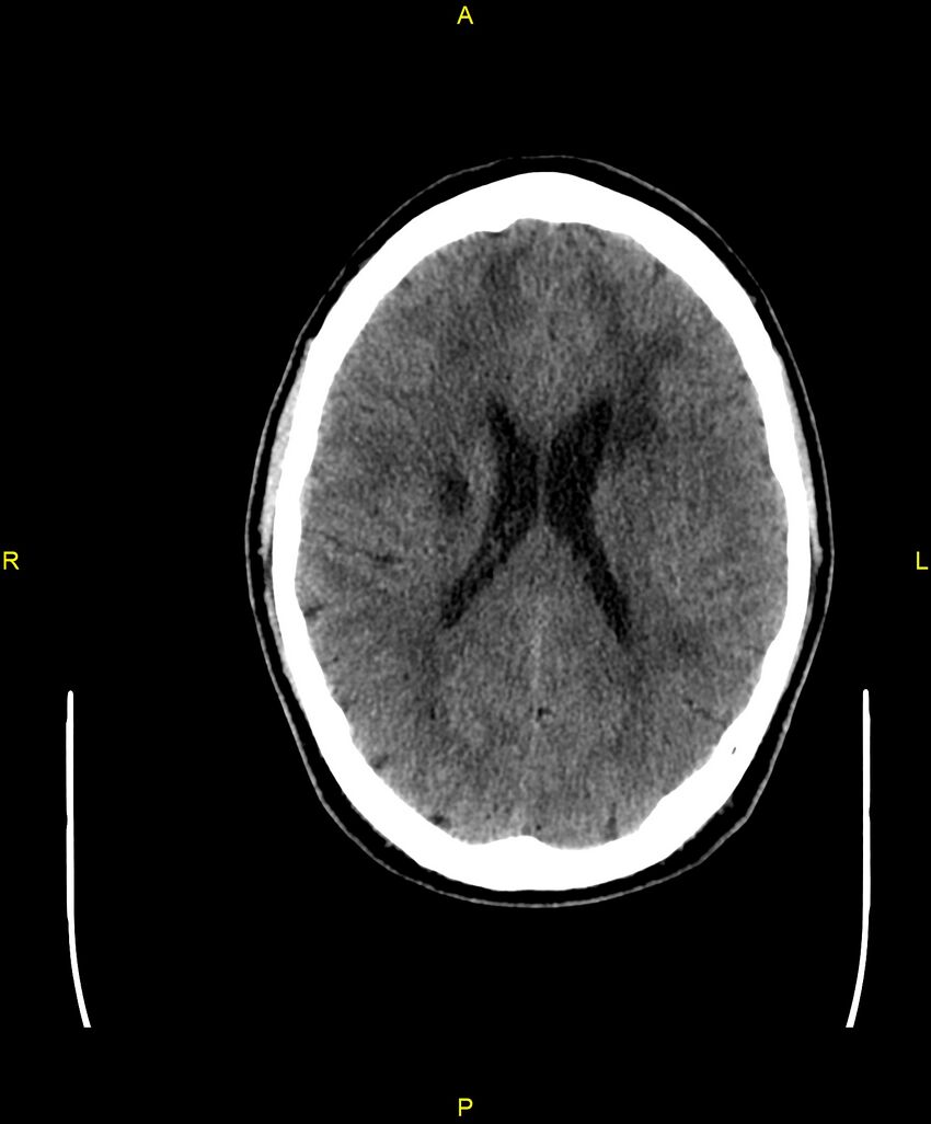 Cerebral autosomal dominant arteriopathy with subcortical infarcts and leukoencephalopathy (CADASIL) (Radiopaedia 86108-102051 Axial non-contrast 67).jpg