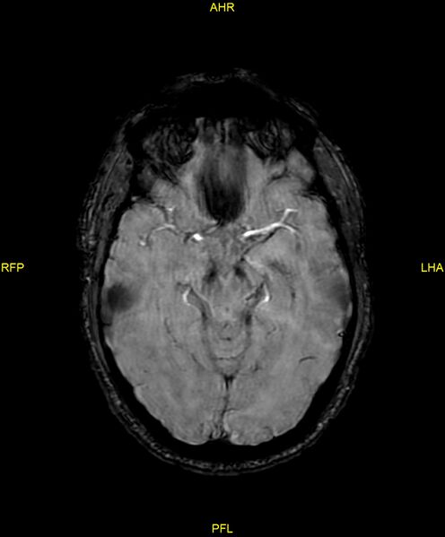 File:Cerebral autosomal dominant arteriopathy with subcortical infarcts and leukoencephalopathy (CADASIL) (Radiopaedia 86108-102054 Axial SWI 46).jpg