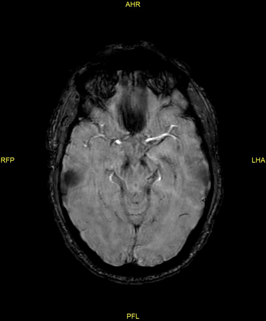 Cerebral autosomal dominant arteriopathy with subcortical infarcts and leukoencephalopathy (CADASIL) (Radiopaedia 86108-102054 Axial SWI 46).jpg