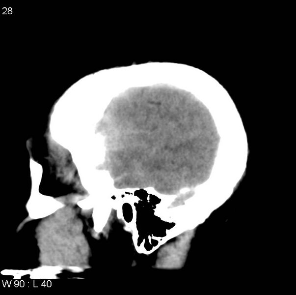 File:Cerebral hemorrhagic contusion with subdural and subarachnoid hemorrhage (Radiopaedia 10680-11146 C 21).jpg