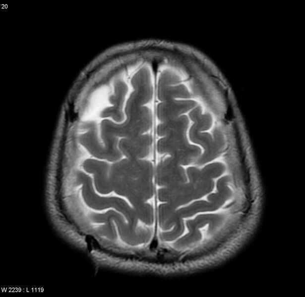 File:Cerebral vasculitis (Radiopaedia 5131-6923 Axial T2 10).jpg