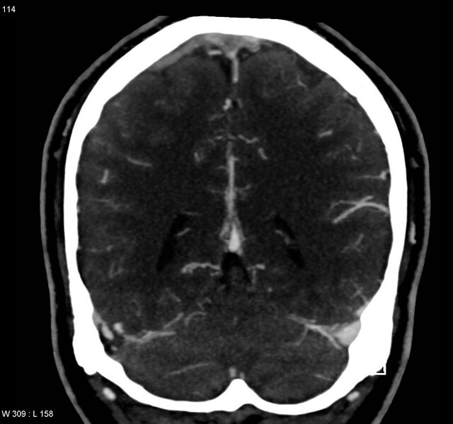 File:Cerebral vein thrombosis (Radiopaedia 4408-6629 Coronal Venous phase 1).jpg