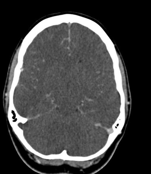 File:Cerebral venous sinus thrombosis (Radiopaedia 59224-66646 Axial C+ delayed 33).jpg