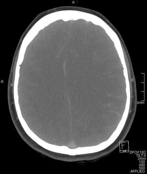 File:Cerebral venous sinus thrombosis (Radiopaedia 91329-108965 Axial venogram 55).jpg
