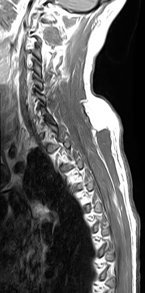 File:Cervical compressive myelopathy (Radiopaedia 71956-82411 Sagittal T1 C+ 3).jpg