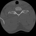 Cervical flexion teardrop fracture with cord hemorrhage (Radiopaedia 32497-33454 Axial bone window 71).jpg