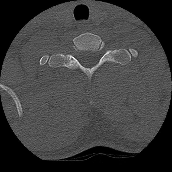 File:Cervical flexion teardrop fracture with cord hemorrhage (Radiopaedia 32497-33454 Axial bone window 71).jpg