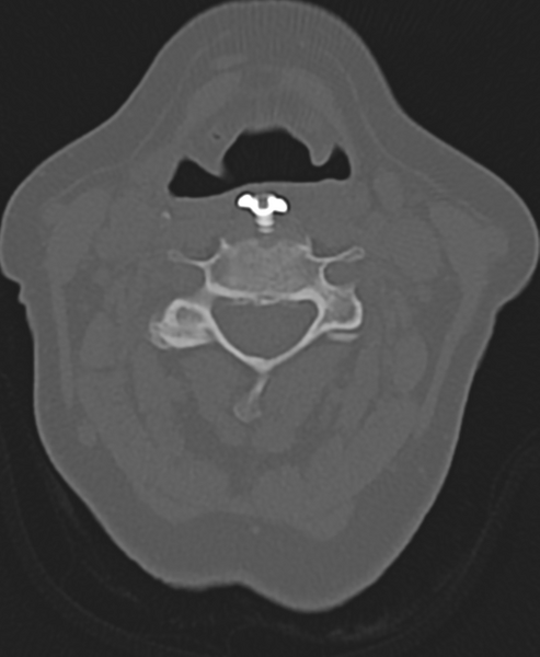 File:Cervical spine ACDF loosening (Radiopaedia 48998-54071 Axial bone window 28).png