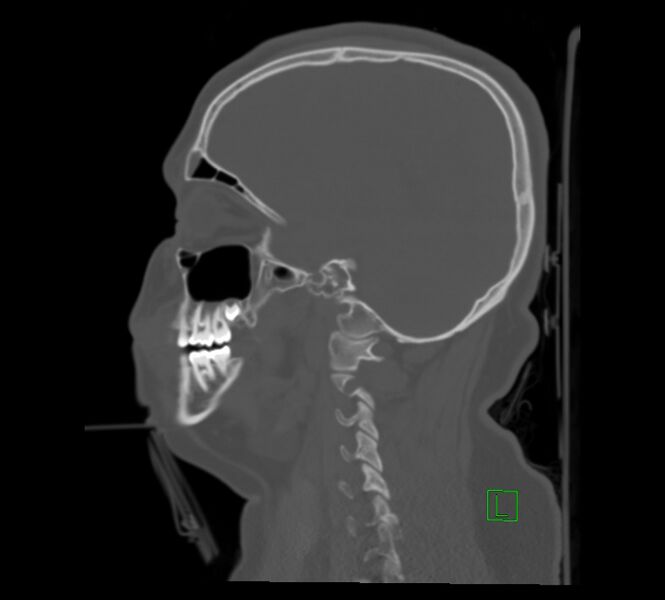 File:Cervical spine fracture - hyperflexion injury (Radiopaedia 66184-75364 A 21).jpg