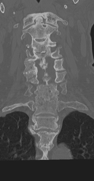 File:Cervical spine fracture in the setting of ankylosis (Radiopaedia 37038-38715 Coronal bone window 32).png