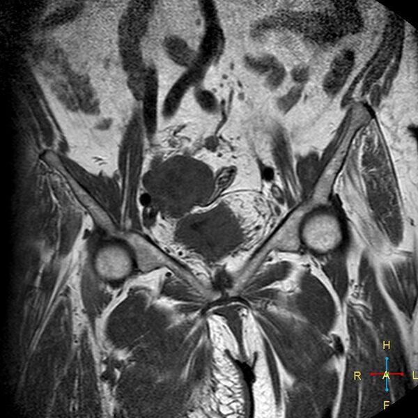 File:Cervical stump squamous cell carcinoma (Radiopaedia 48049-52858 Coronal T1 4).jpg