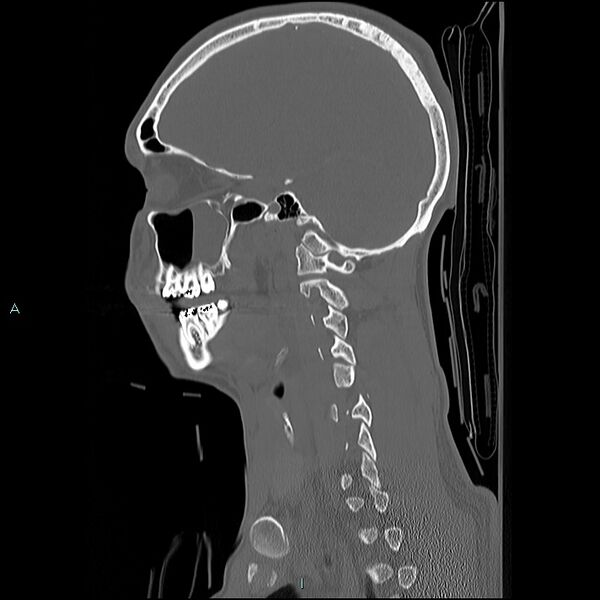 File:Cervical vertebral burst fracture (Radiopaedia 37420-39258 Sagittal bone window 6).jpg