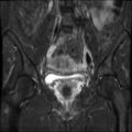 Cesarian section scar endometriosis (Radiopaedia 66520-75799 Coronal STIR 17).jpg