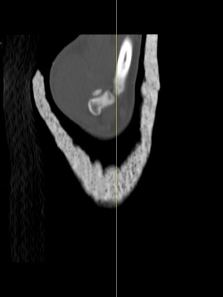 File:Chauffeur's (Hutchinson) fracture (Radiopaedia 58043-65079 Sagittal bone window 23).jpg