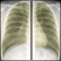 Chest x-ray - breathing (Radiopaedia 32556-33507 B 1).png