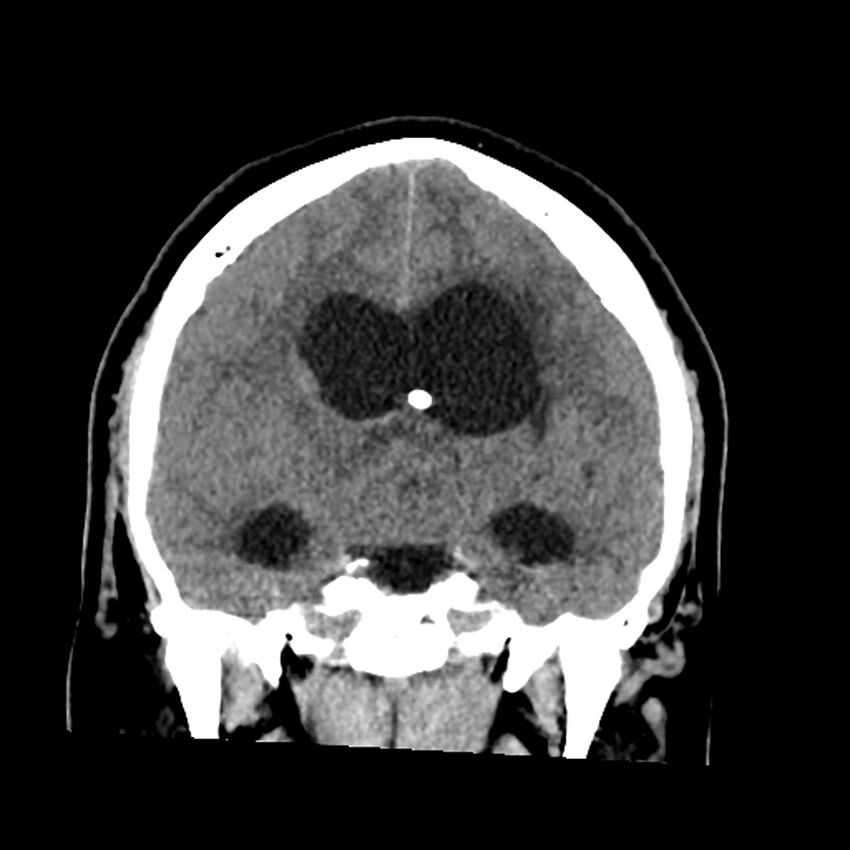 Chiasmatic-hypothalamic juvenile pilocytic astrocytoma (Radiopaedia 78533-91237 Coronal non-contrast 34).jpg