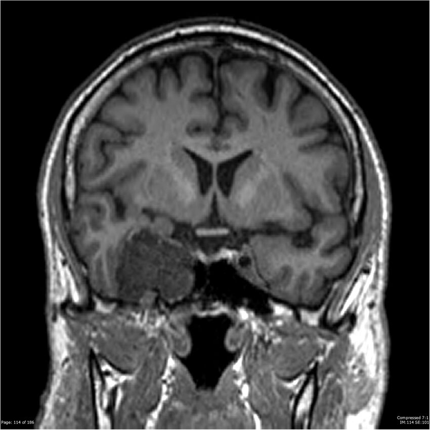 Chondrosarcoma of skull base- grade II (Radiopaedia 40948-43654 Coronal T1 35).jpg