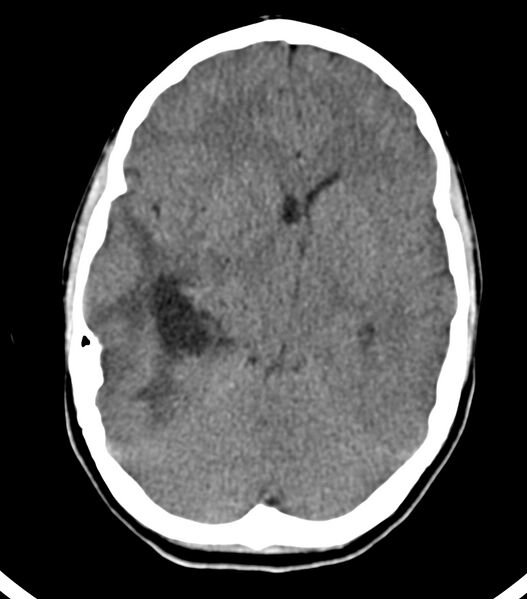 File:Choroid plexus carcinoma (Radiopaedia 91013-108552 Axial non-contrast 26).jpg