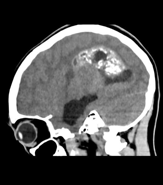 File:Choroid plexus carcinoma (Radiopaedia 91013-108552 B 51).jpg