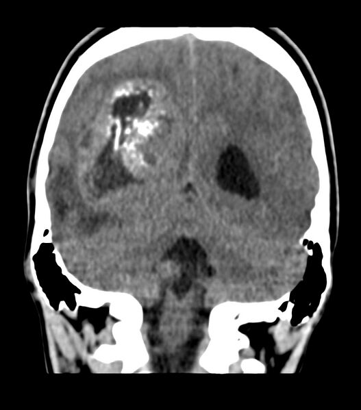 File:Choroid plexus carcinoma (Radiopaedia 91013-108552 Coronal non-contrast 61).jpg