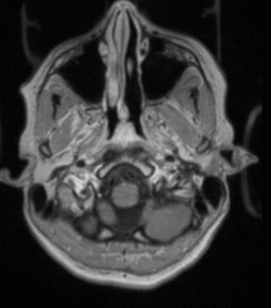 File:Choroid plexus carcinoma (Radiopaedia 91013-108553 Axial T1 C+ 80).jpg